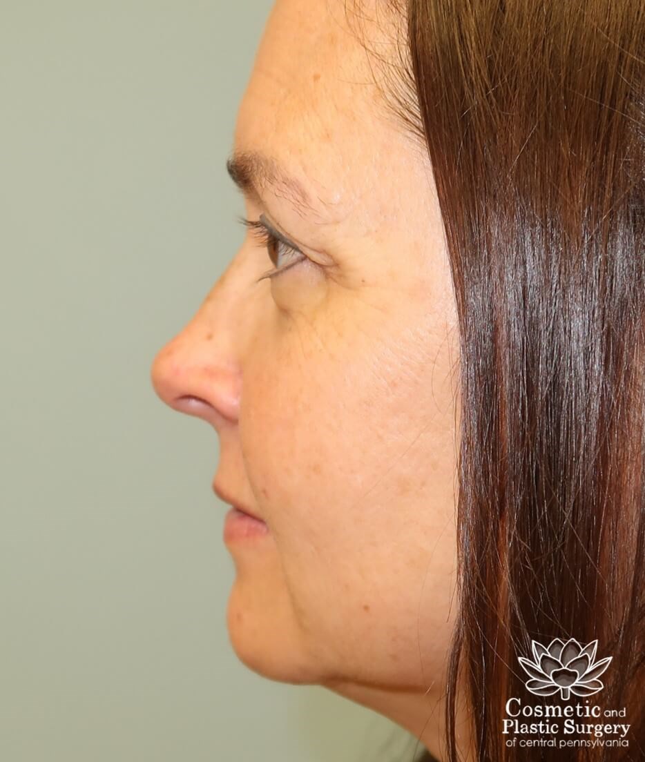 Upper Eyelid Blepharoplasty Before