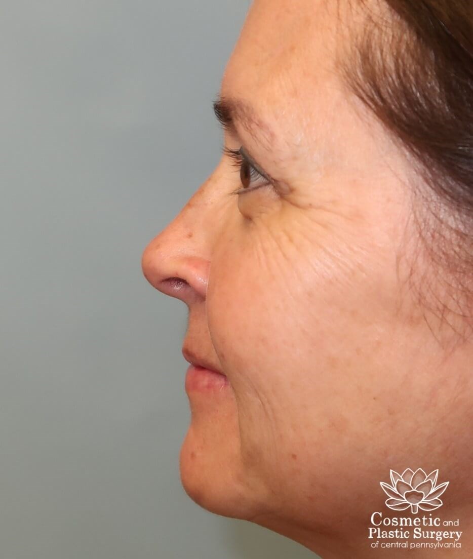Upper Eyelid Blepharoplasty After