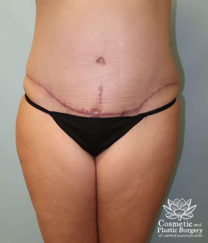 Tummy Tuck After