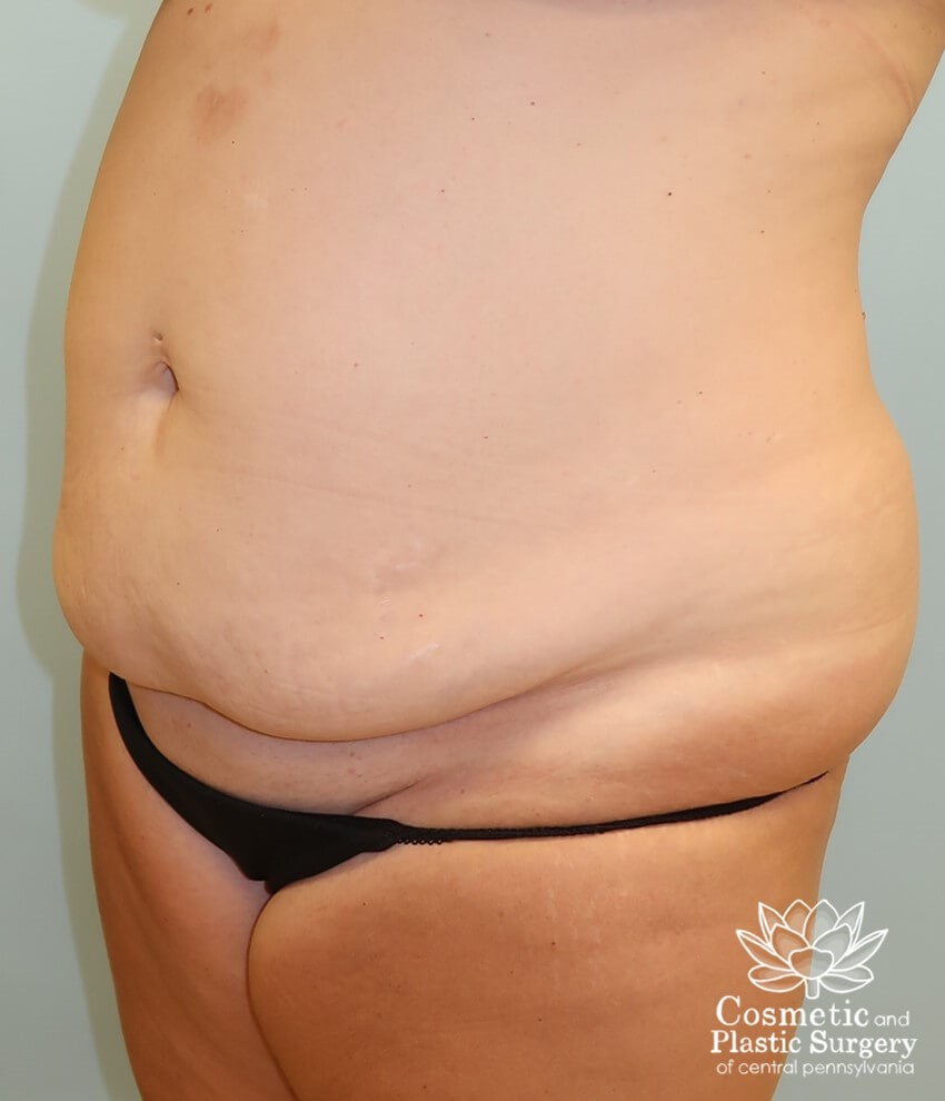 Tummy Tuck Before