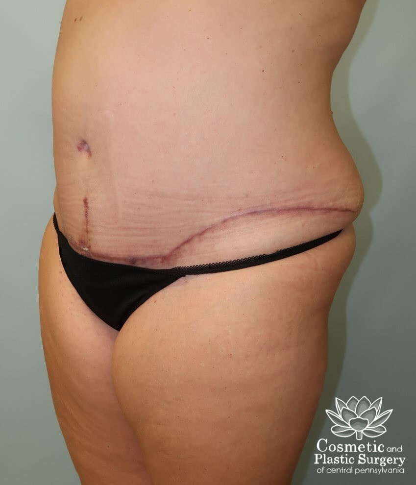 Tummy Tuck After