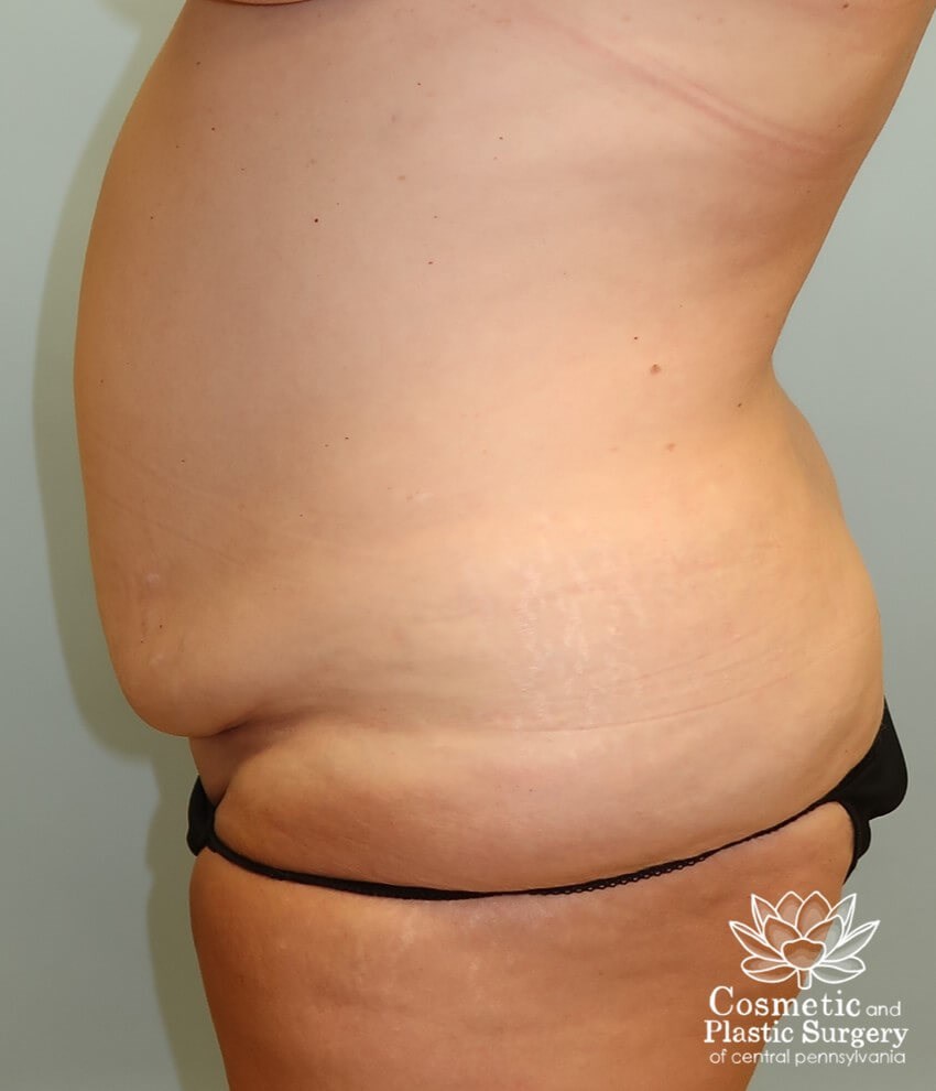 Tummy Tuck Before