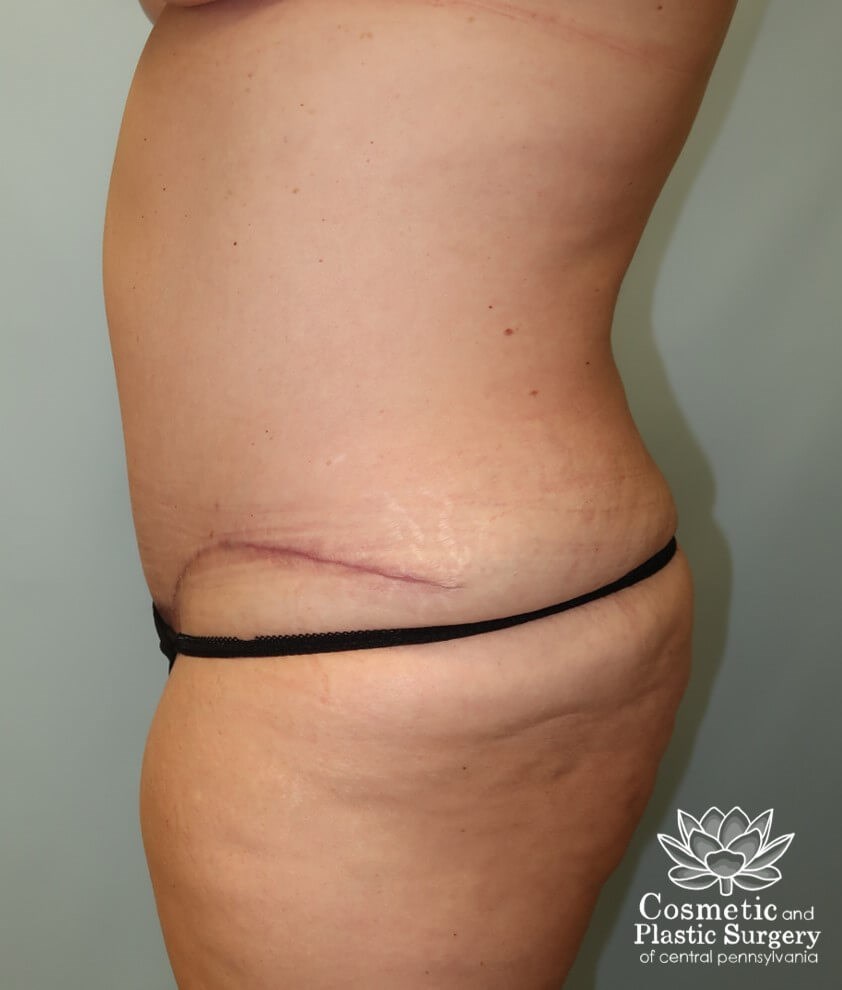 Tummy Tuck After