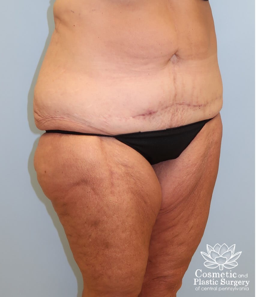Circumferential Body Lift Before