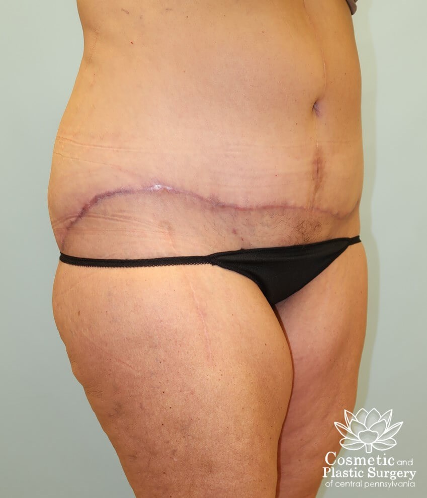 Circumferential Body Lift After