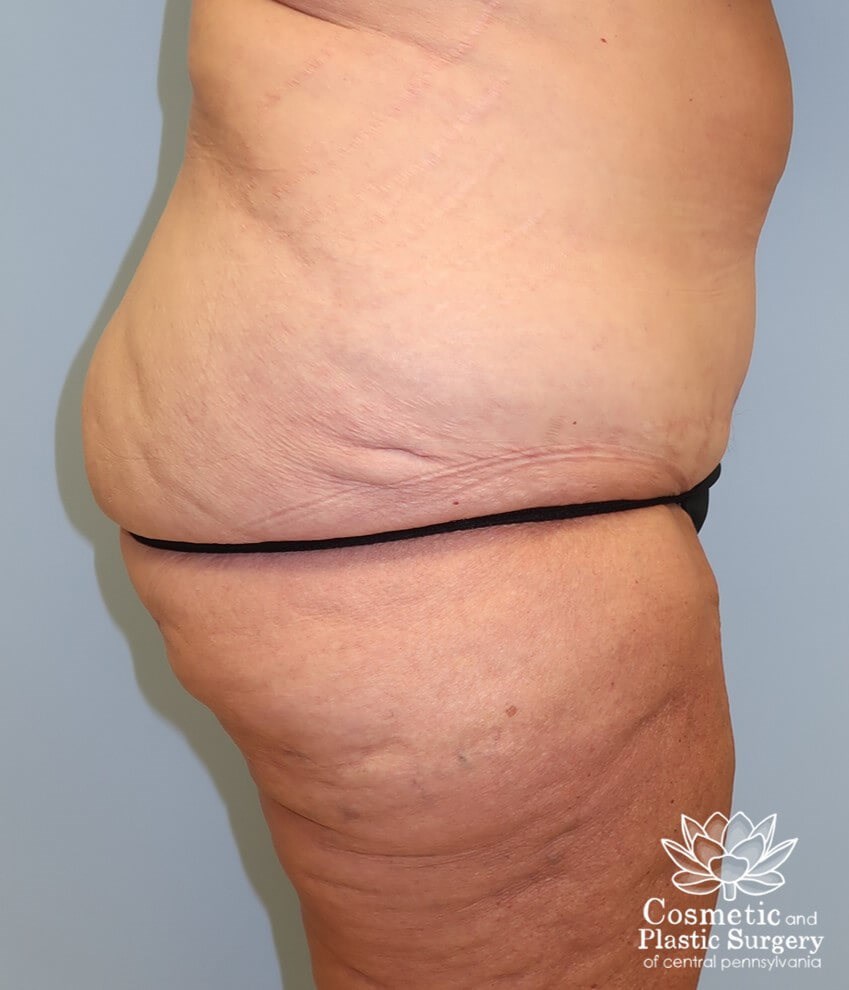 Circumferential Body Lift Before