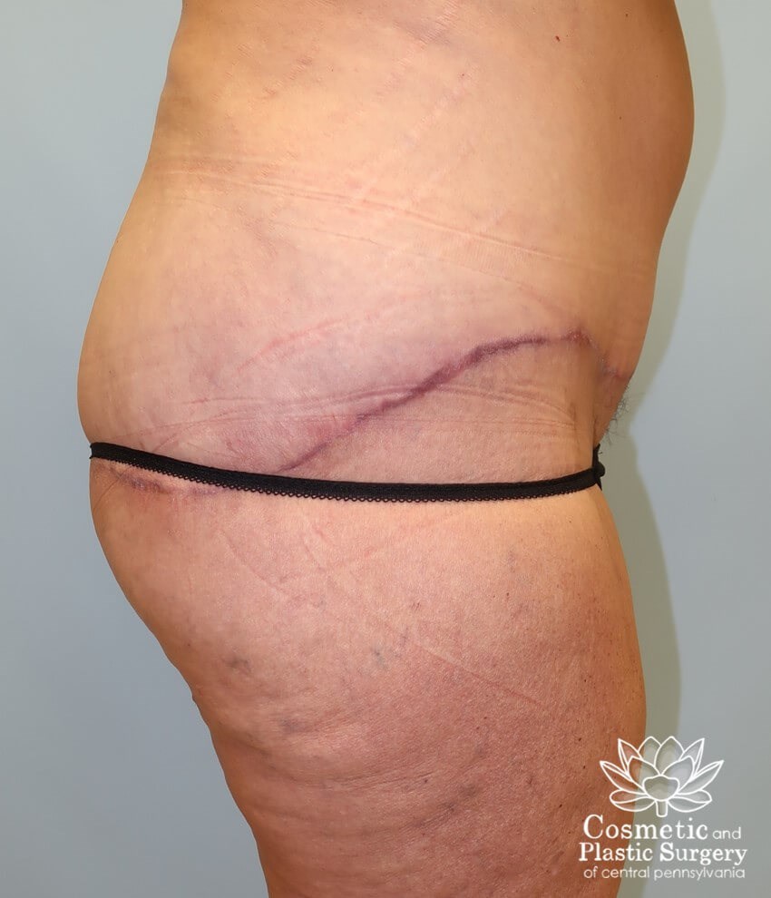 Circumferential Body Lift After