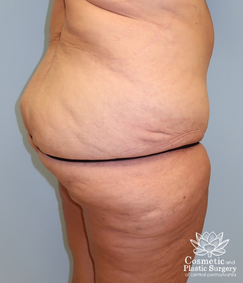 Circumferential Body Lift Before