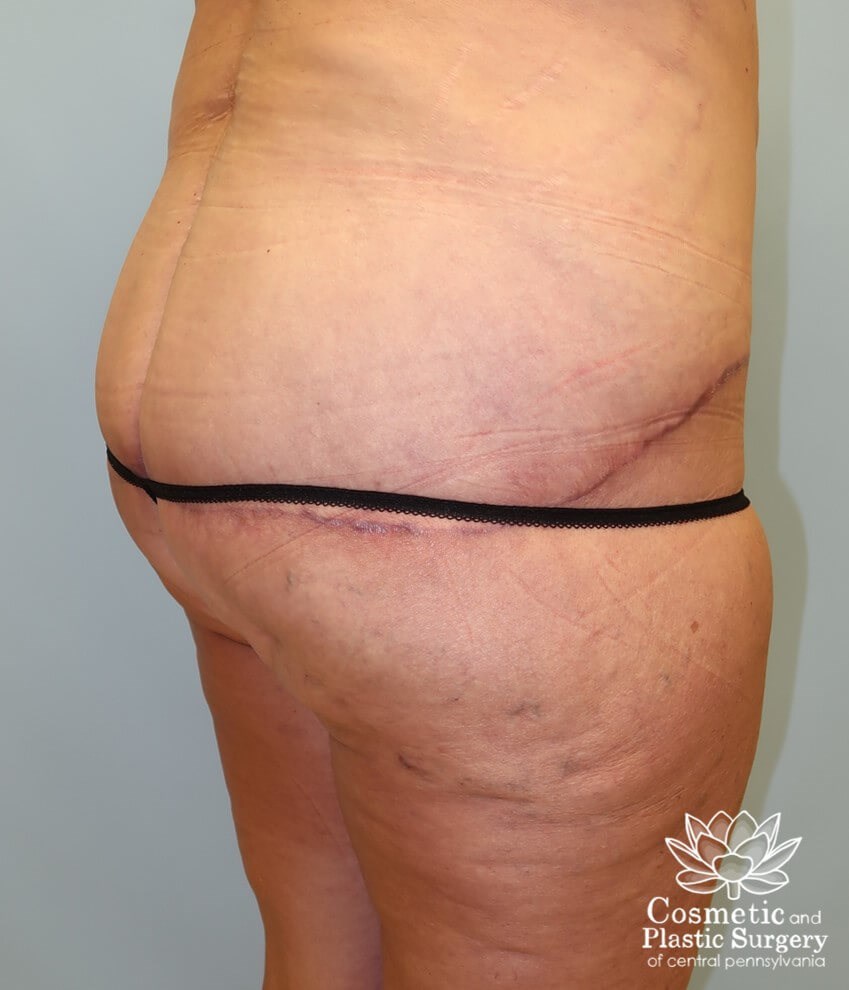 Circumferential Body Lift After