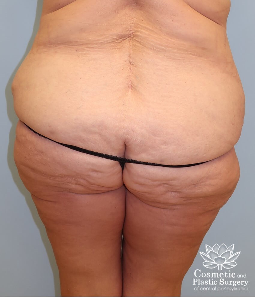 Circumferential Body Lift Before