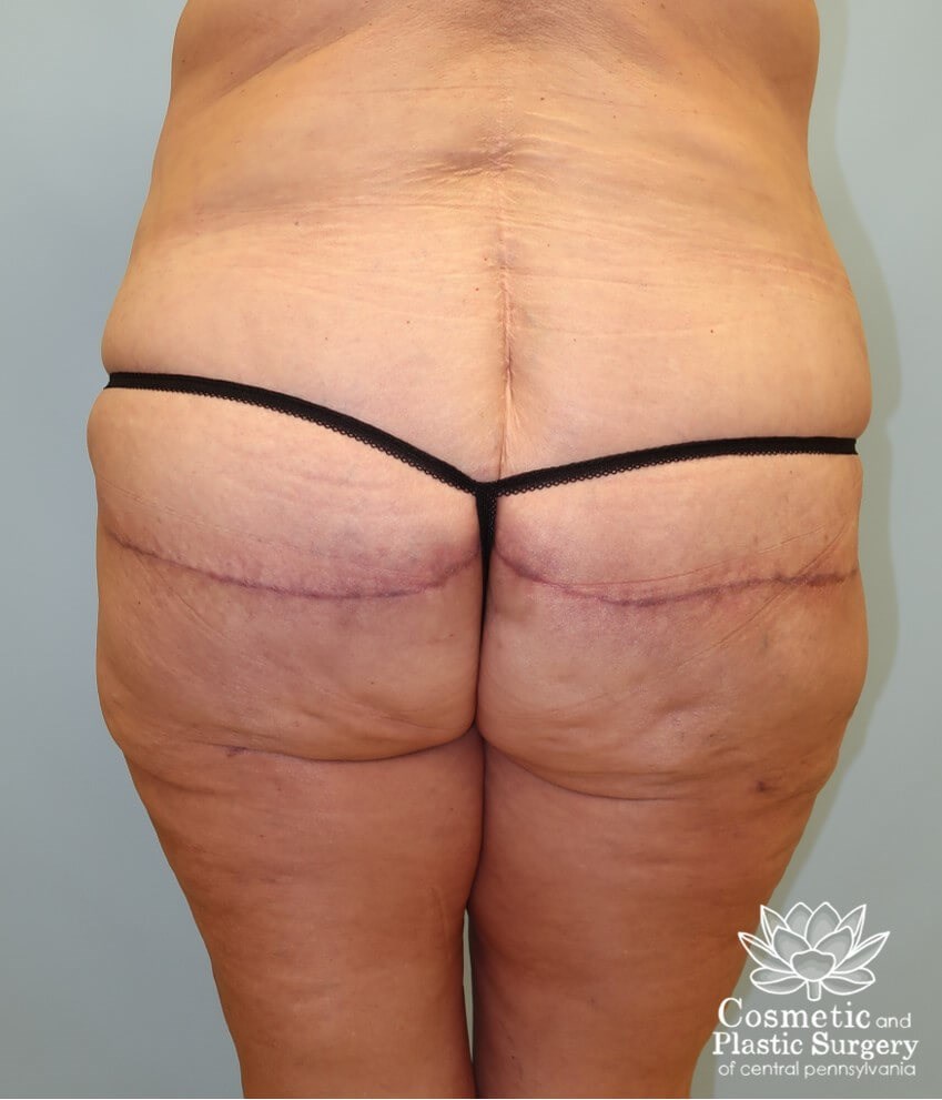 Circumferential Body Lift After