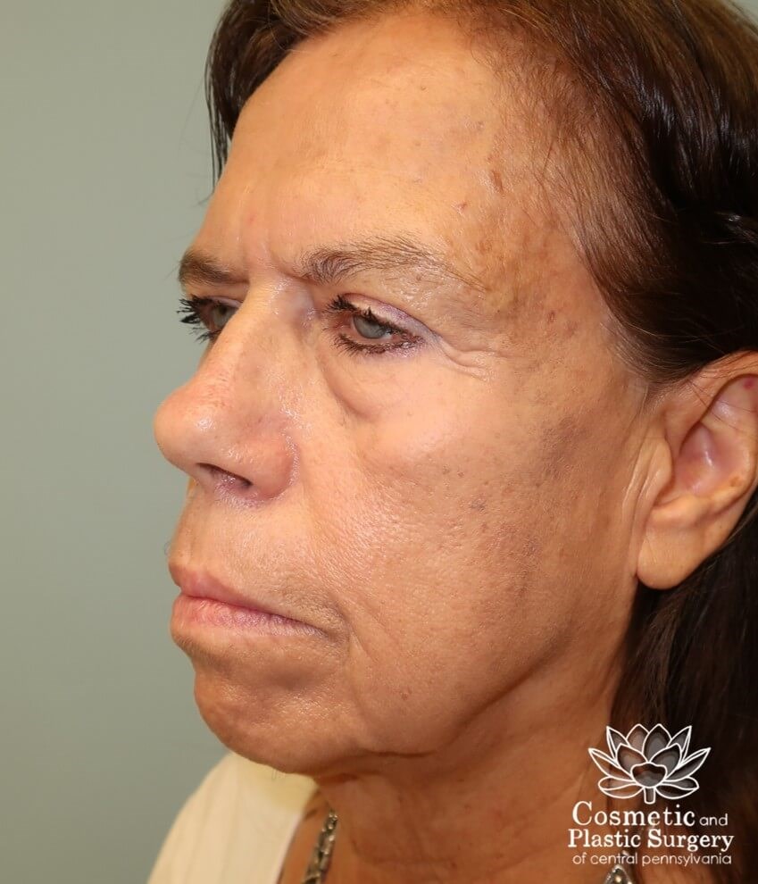 Upper Blepharoplasty/Browlift Before