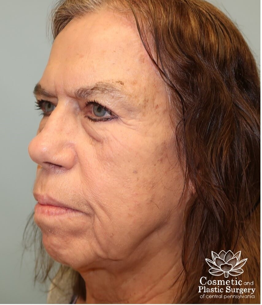 Upper Blepharoplasty/Browlift After