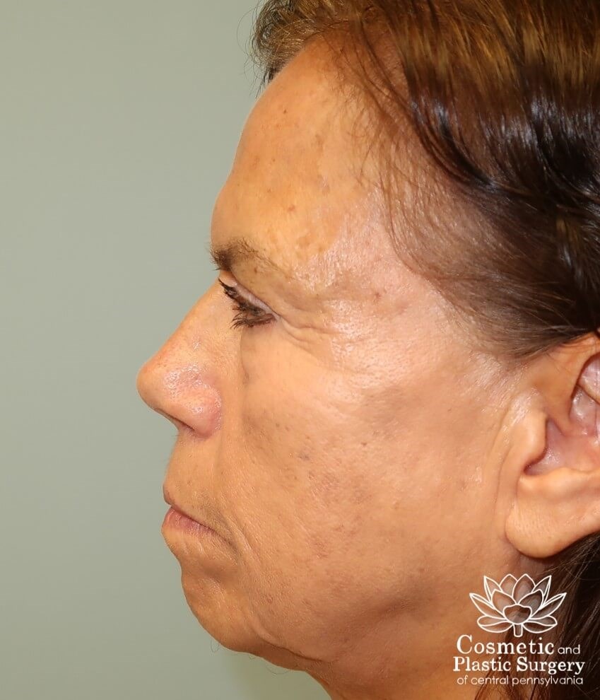 Upper Blepharoplasty/Browlift Before