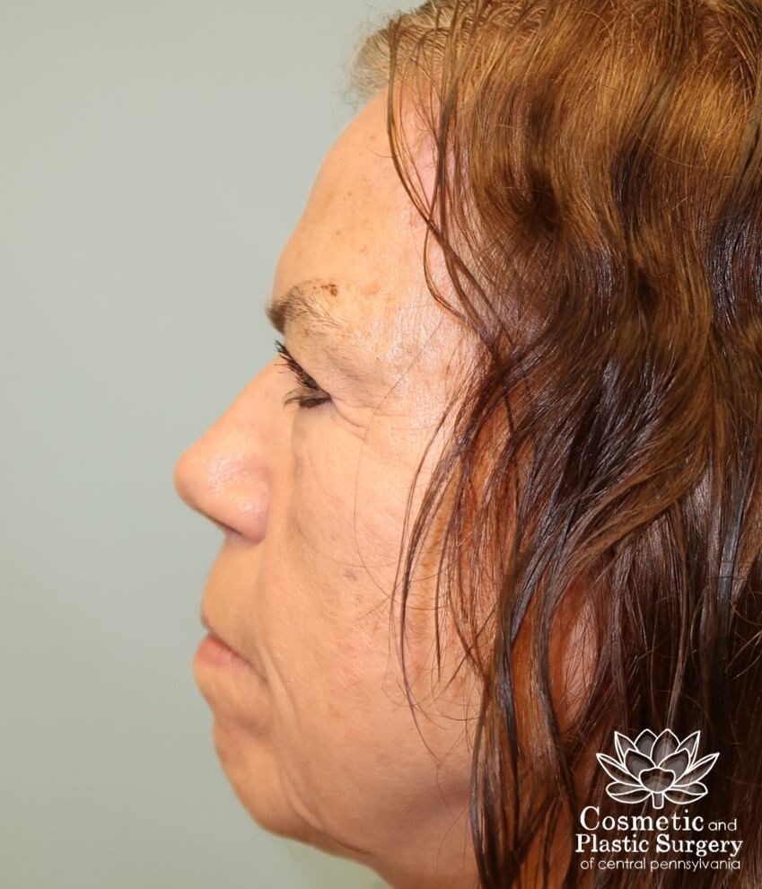 Upper Blepharoplasty/Browlift After