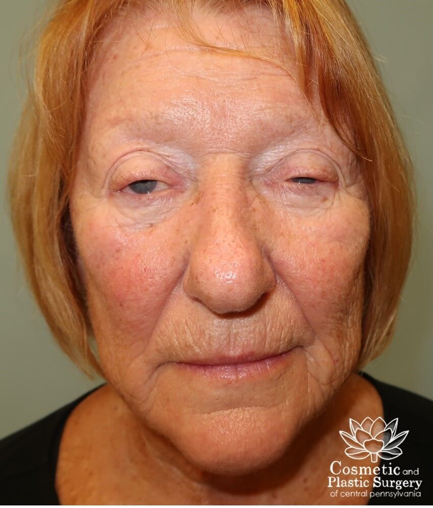Upper Eyelid Blepharoplasty Before
