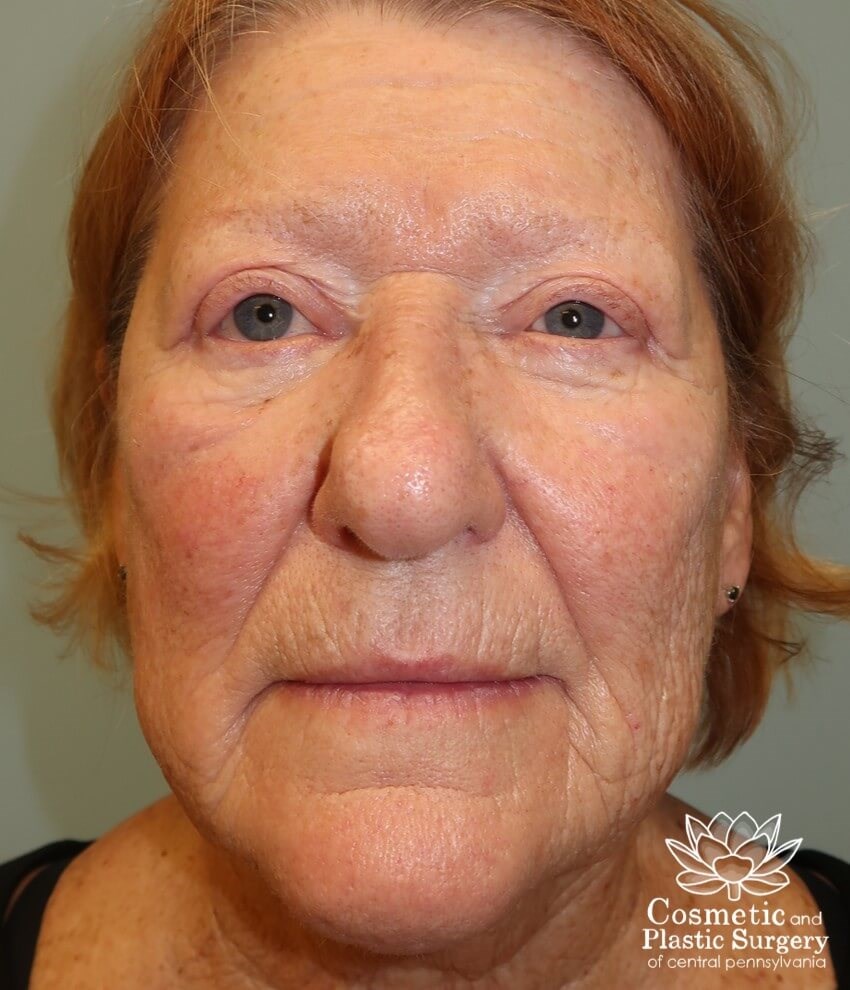 Upper Eyelid Blepharoplasty After