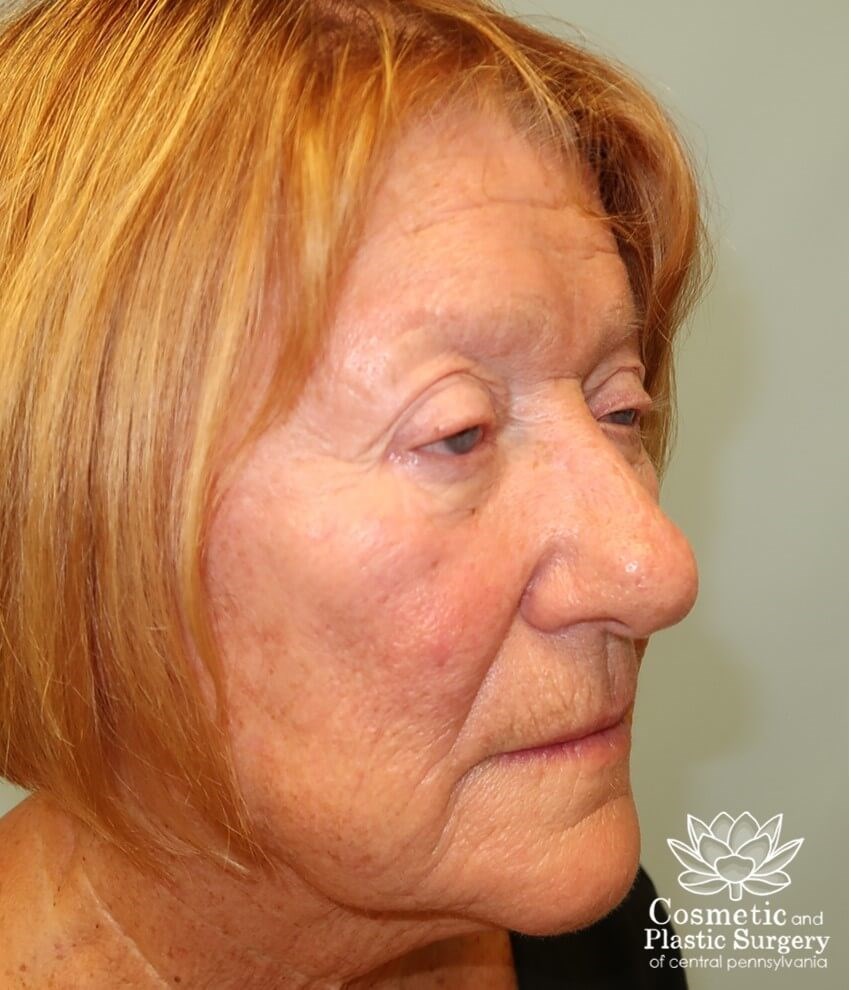 Upper Eyelid Blepharoplasty Before