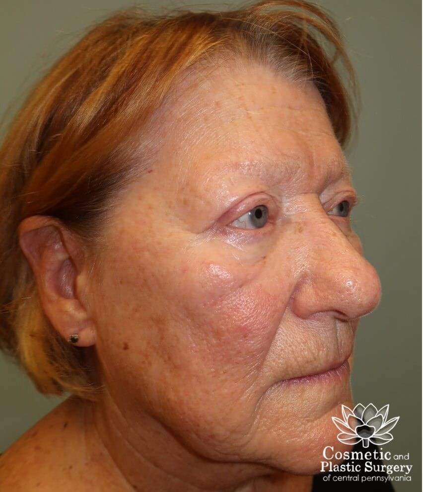Upper Eyelid Blepharoplasty After