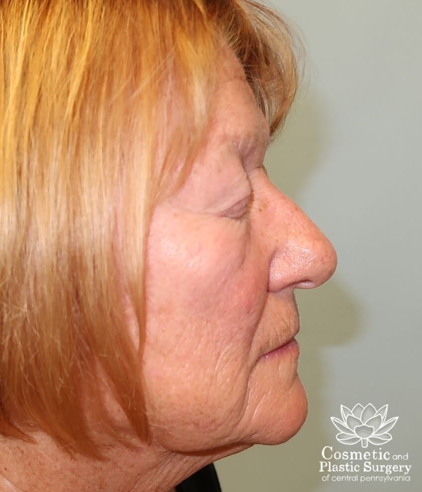 Upper Eyelid Blepharoplasty Before