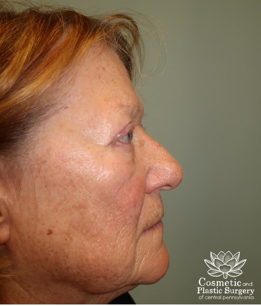 Upper Eyelid Blepharoplasty After