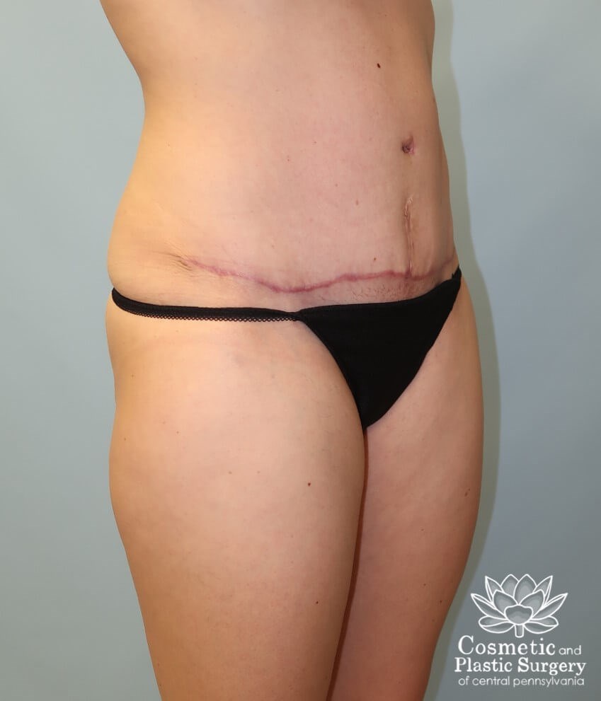 Tummy Tuck After