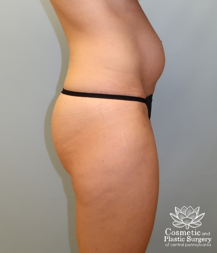 Tummy Tuck Before