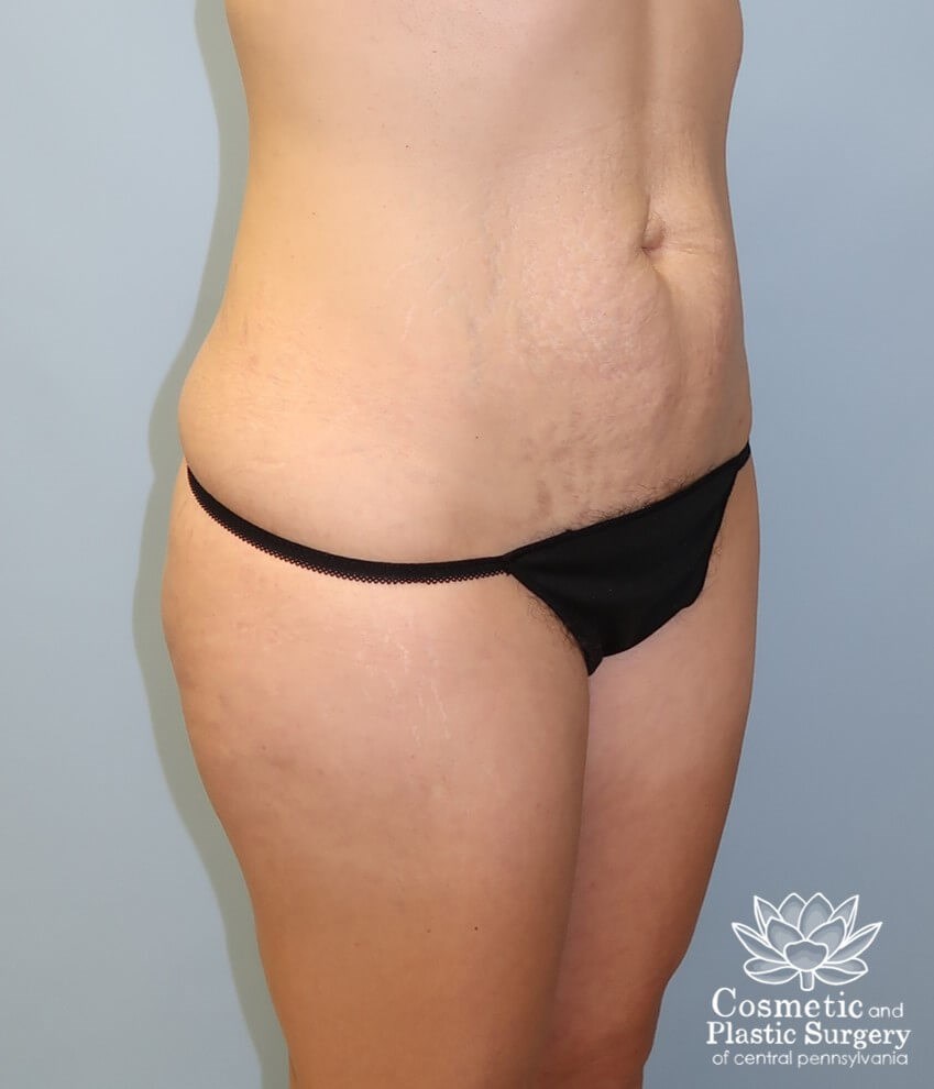Tummy Tuck and Liposuction Before