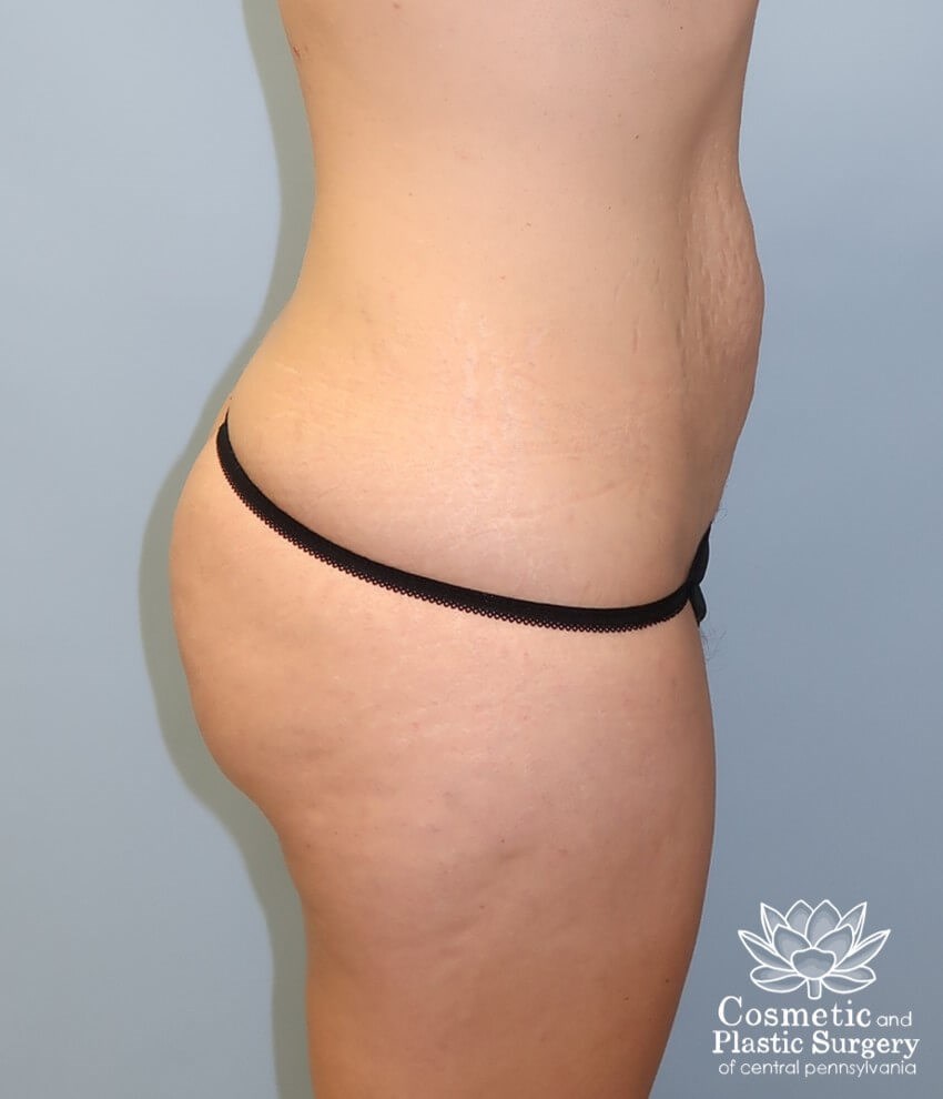 Tummy Tuck and Liposuction Before