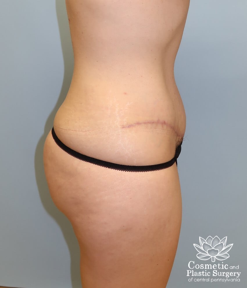 Tummy Tuck and Liposuction After