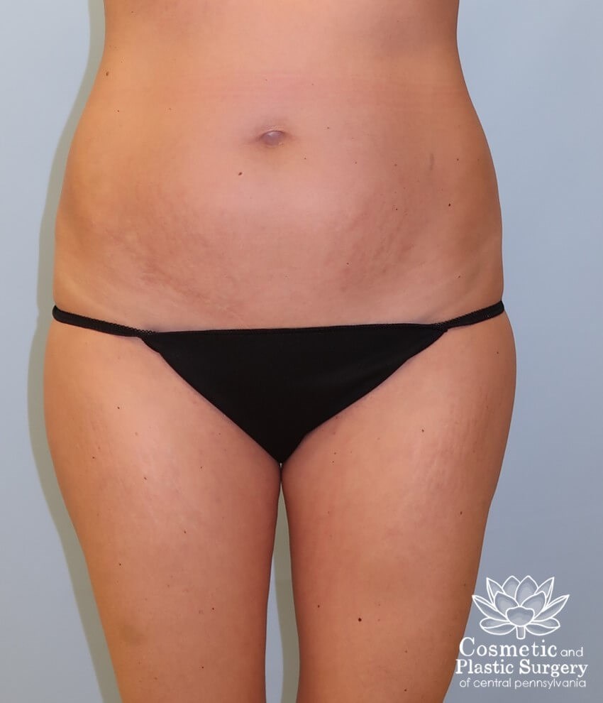 Breast Augmentation Before
