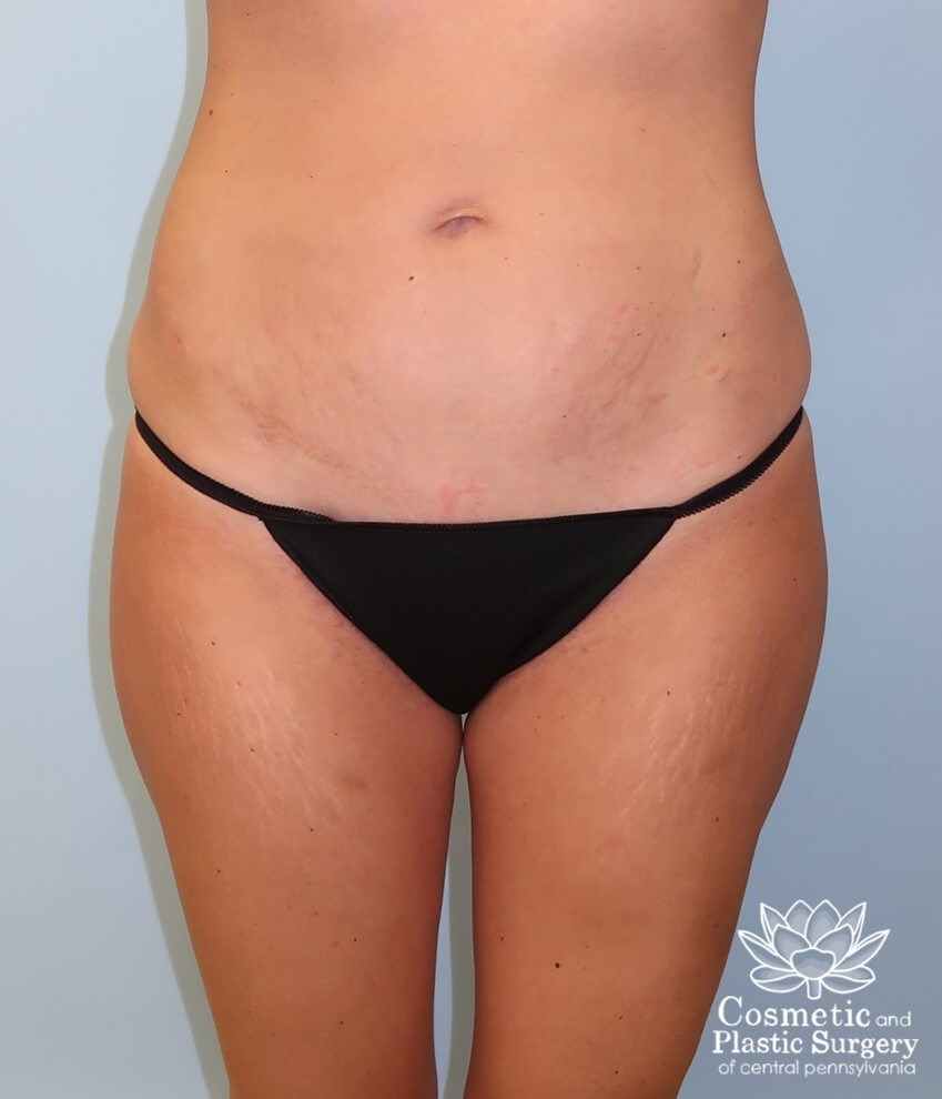 Breast Augmentation After