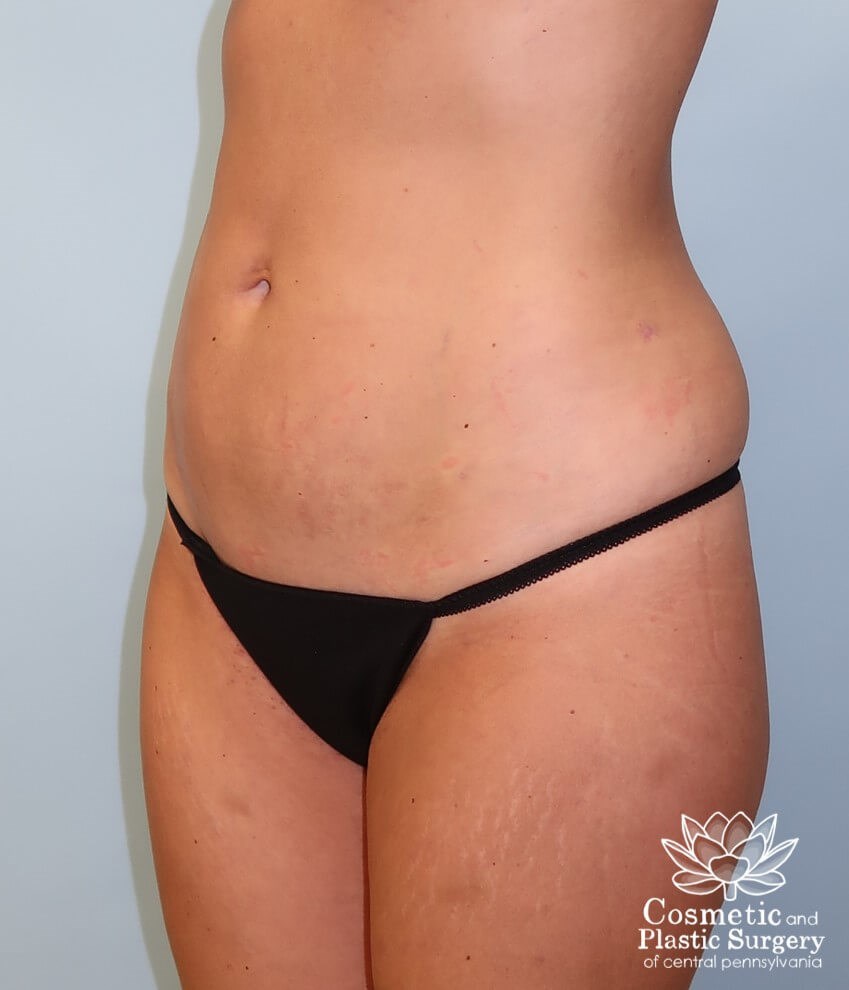 Breast Augmentation After