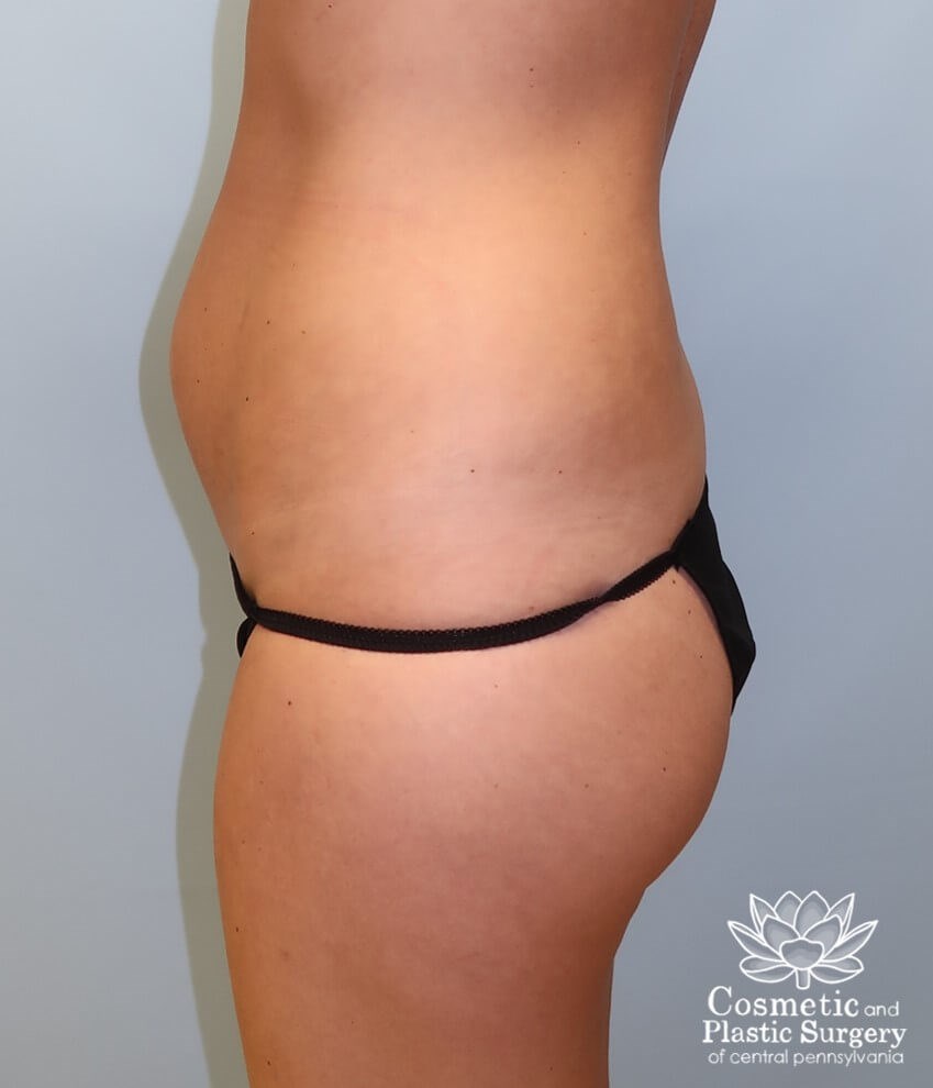 Breast Augmentation Before