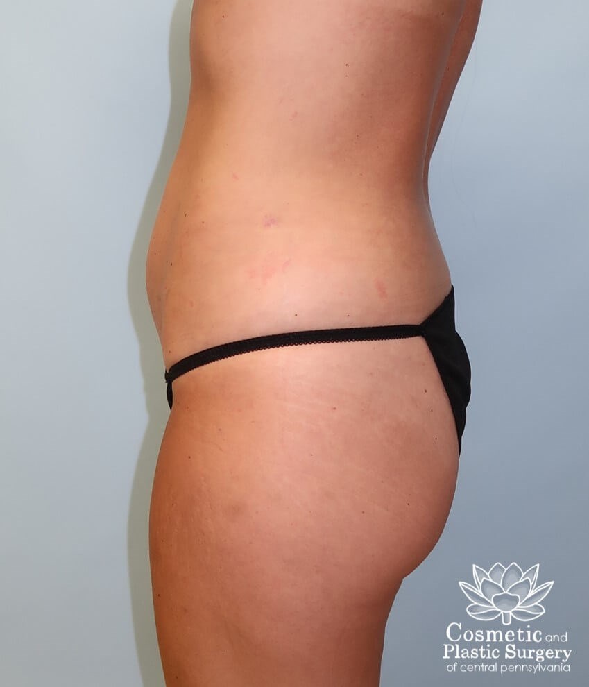 Breast Augmentation After