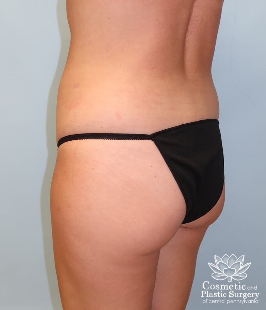 Breast Augmentation After
