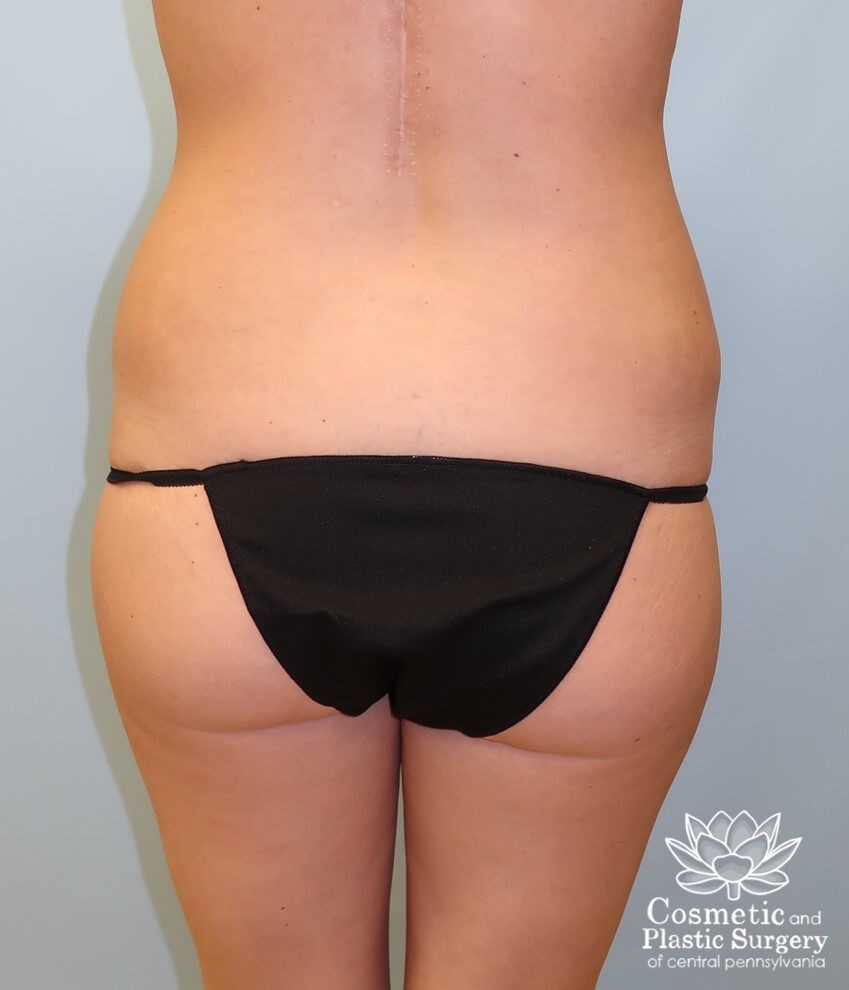 Breast Augmentation Before