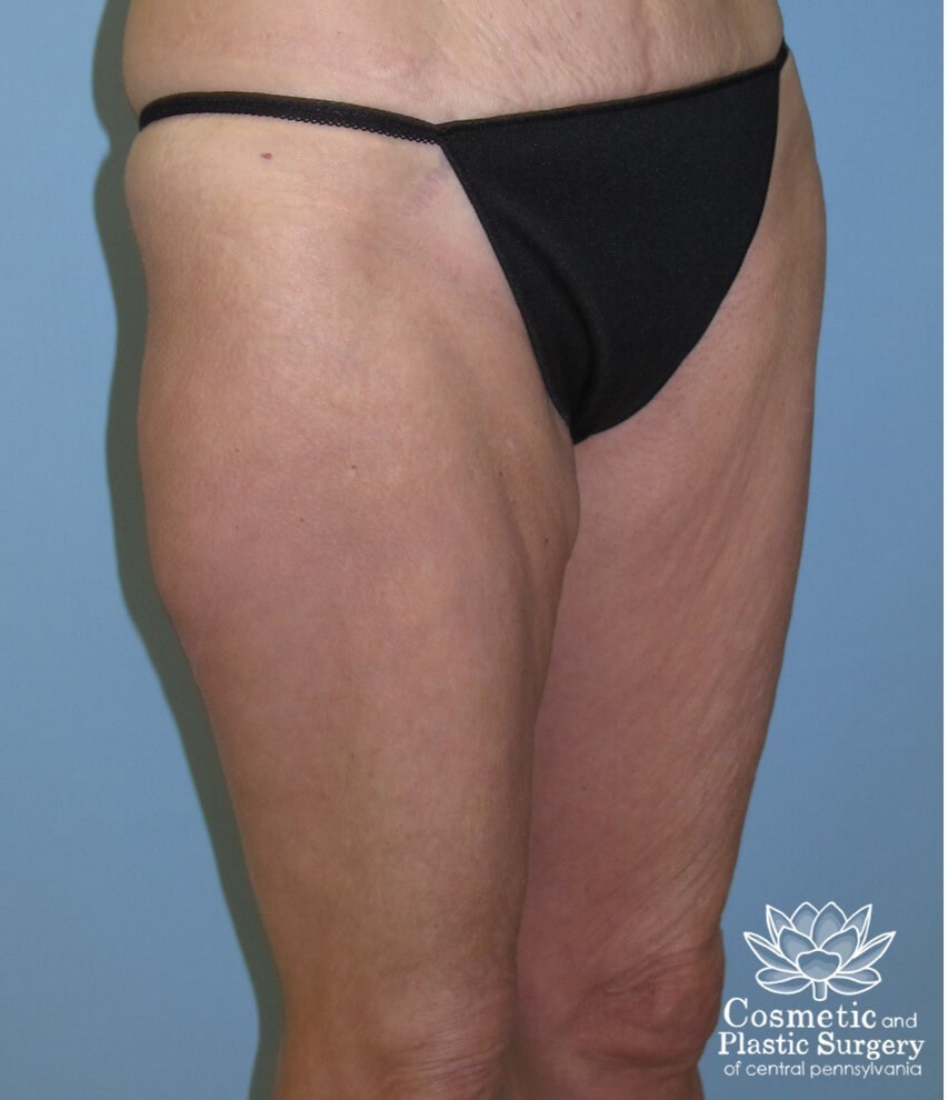 Thighplasty Before