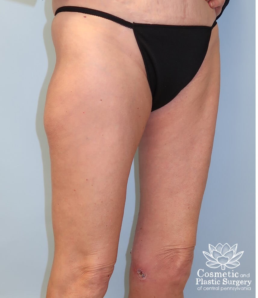 Thighplasty After