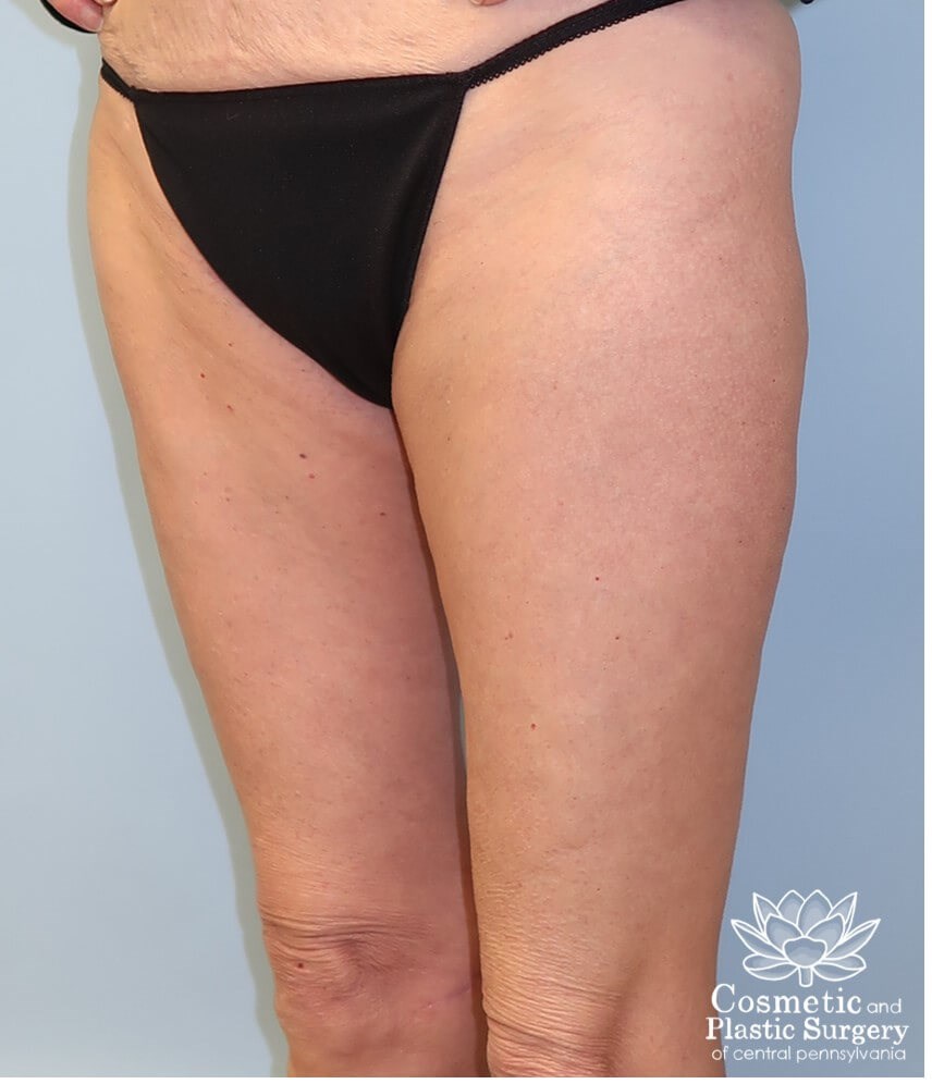 Thighplasty After