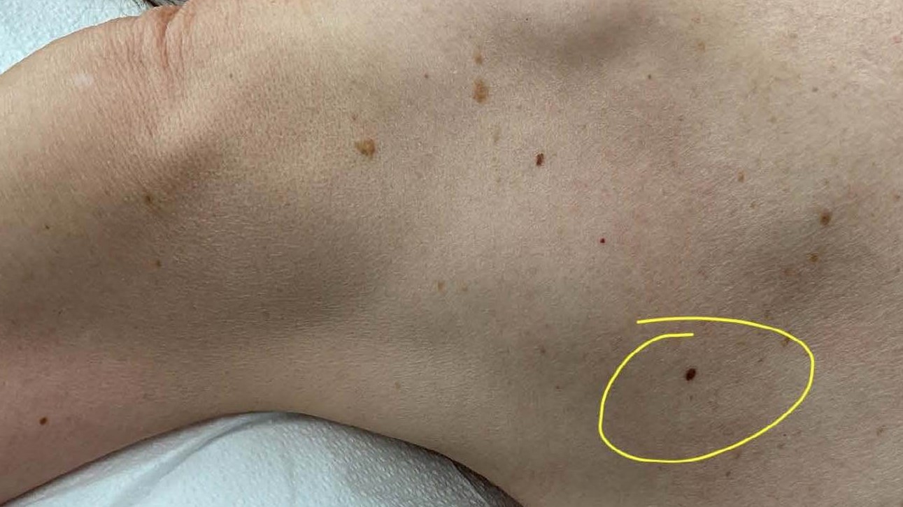 Severe atypical nevus