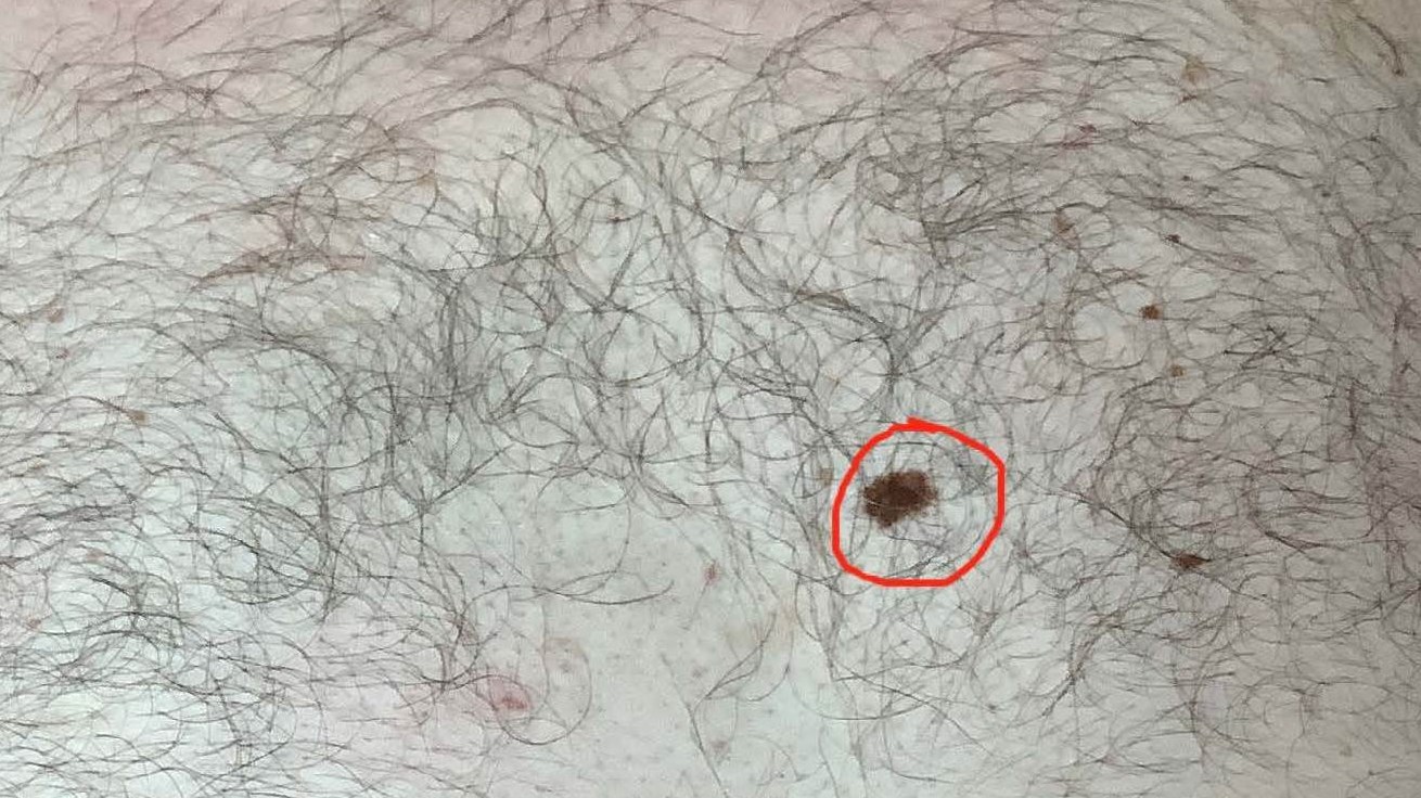 Melanoma insitu