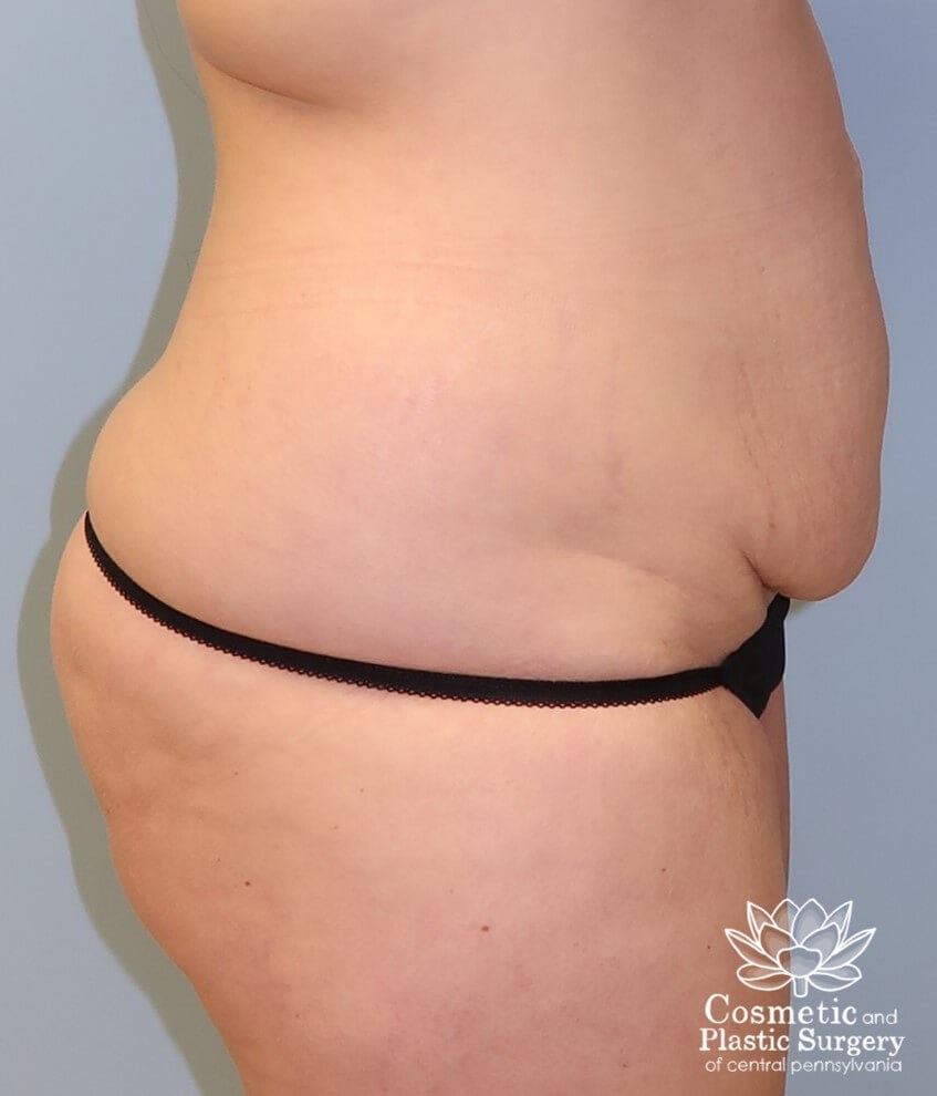 Tummy Tuck and Liposuction Before