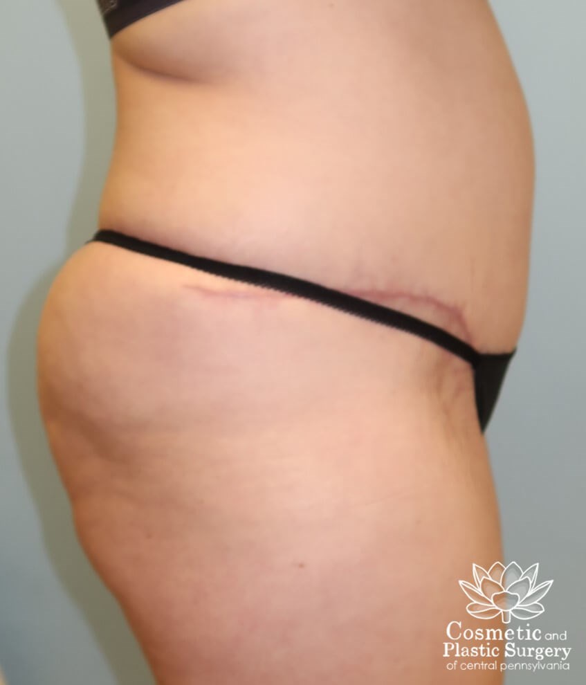 Tummy Tuck and Liposuction After