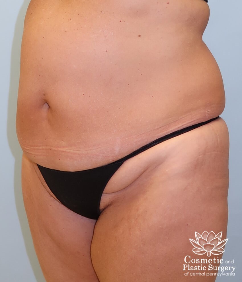 Tummy Tuck and Liposuction Before