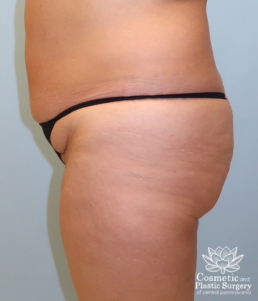 Tummy Tuck and Liposuction Before