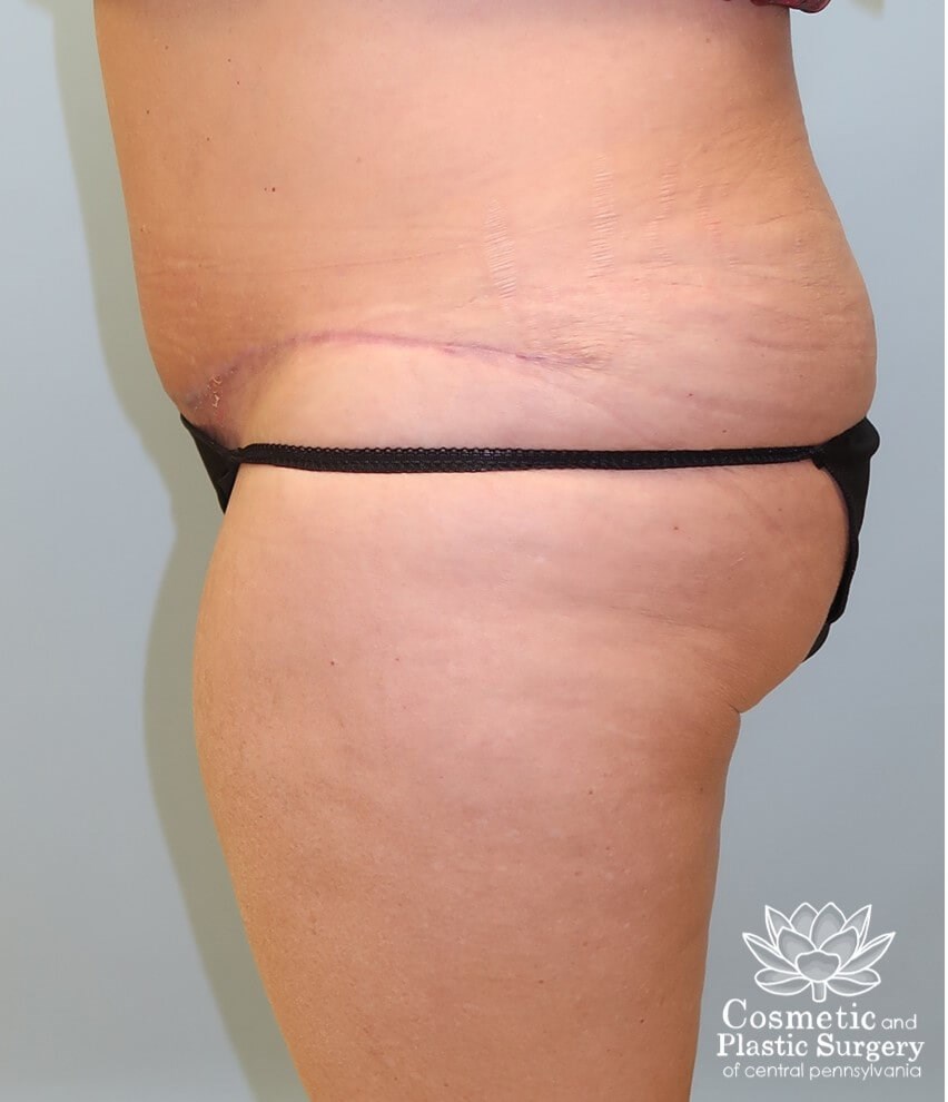 Tummy Tuck and Liposuction After