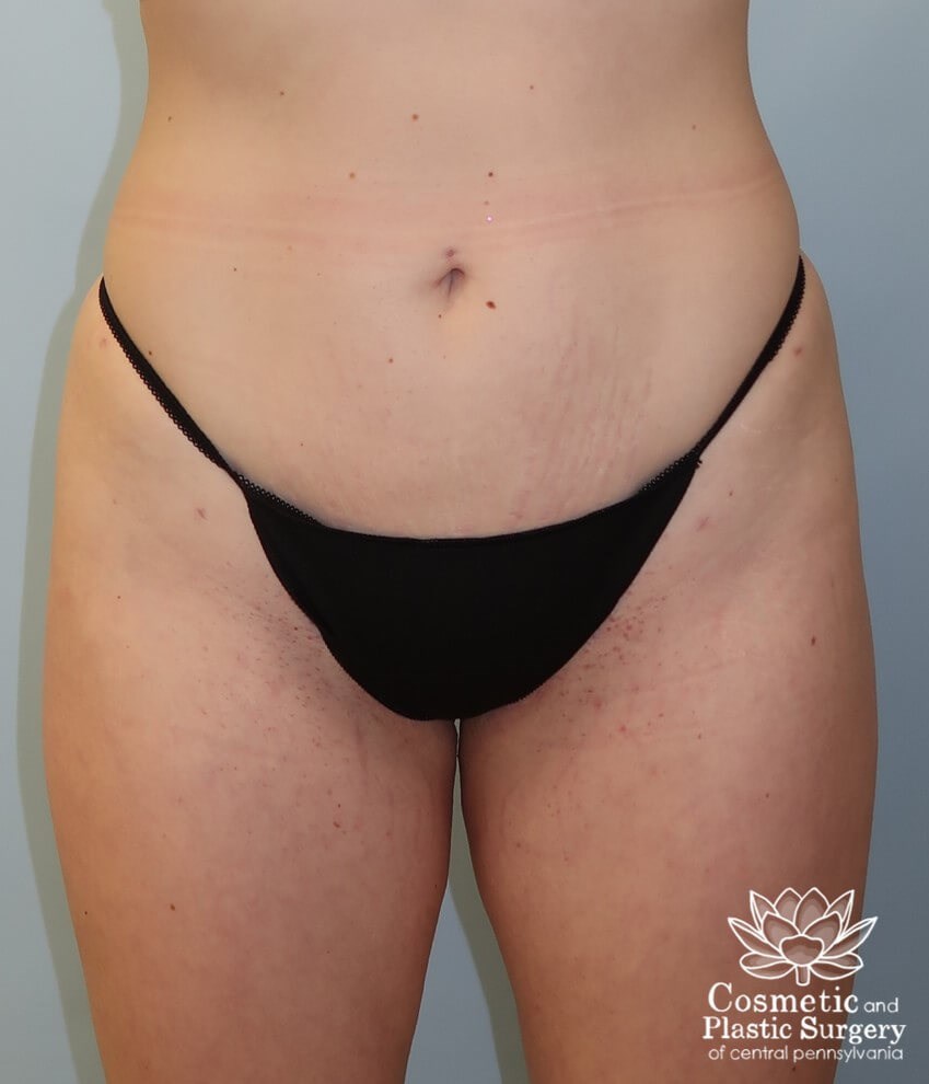 Liposuction After