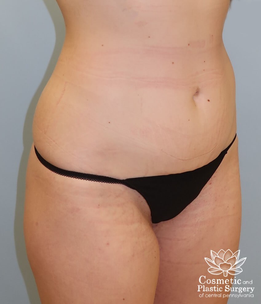 Liposuction Before