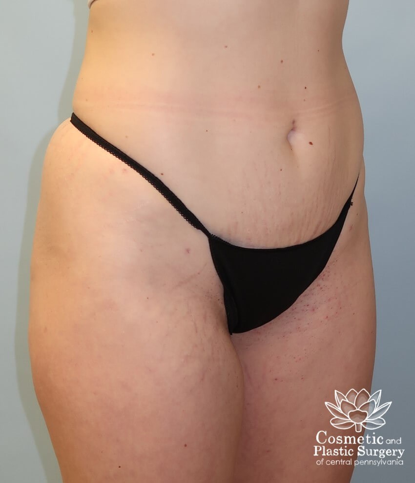 Liposuction After